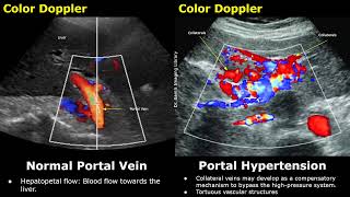 Portal Vein Color amp Spectral Doppler Ultrasound Normal Vs Abnormal Images  Liver Vascular USG Scan [upl. by Snyder181]