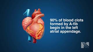 Watchman Procedure for Left Atrial Appendage Occlusion LAAO [upl. by Tal611]