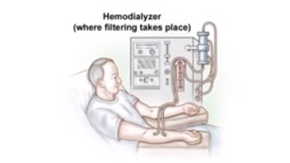 Dialysis Access and Fistula Procedure [upl. by Earej]