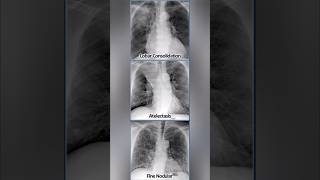 Chest Xrays describing Pathalogies 🩻 medical xray radiology infection disease shorts [upl. by Hayouqes777]