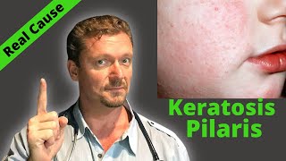 KERATOSIS PILARIS Fix Sign of Serious Condition Chicken Skin Cure [upl. by Rubma]