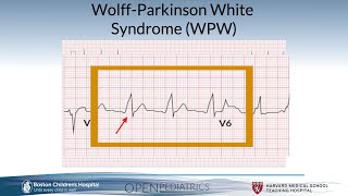 quotWolffParkinsonWhite Syndromequot by Dr Gary Dhillon for OPENPediatrics [upl. by Nohs878]