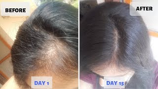 OMG  15 Days Hair Growth Miracle Treatment  Grow Long Thicken Hair  100 works [upl. by Wendy]