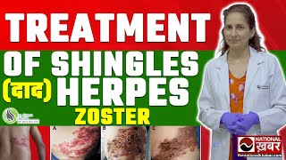 Shingles Herpes Zoster Pathophysiology Risk Factors Phases of Infection Symptoms Treatment [upl. by Annauj867]