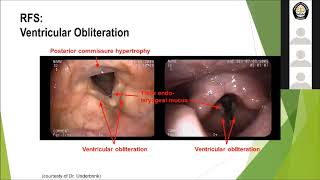 Laryngopharyngeal Reflux LPR [upl. by Lewes]