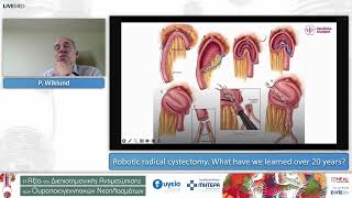 Robotic radical cystectomy What have we learned over 20 years  P Wiklund [upl. by Kravits]