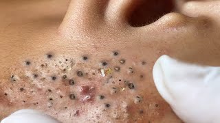 Big Cystic Acne Blackheads Extraction Blackheads amp Milia Whiteheads Removal Pimple Popping  3435 [upl. by Nirak999]