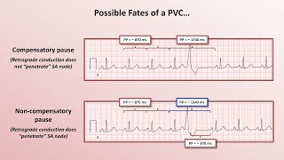 Advanced EKGs  PACs and PVCs ie premature beats [upl. by Aural]