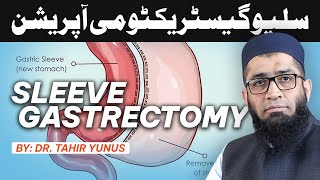 What Is A Sleeve Gastrectomy Effects And Benefits Explained by Dr Tahir Yunus Bariatric surgeon [upl. by Nobe]