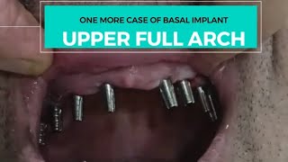 बसल इम्प्लांट्स का एक और कामयाब केसFULL MOUTH CASE OF BASAL IMPLants in just 5 days basalimplants [upl. by Lokkin757]