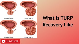 What is TURP Recovery Like [upl. by Earal480]