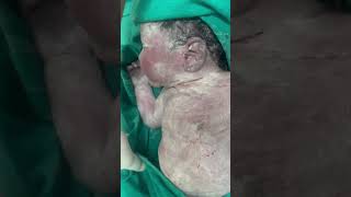 Vernix caseosa a protective sensitive newborn skinnewborn baby ❤️ [upl. by Redfield]