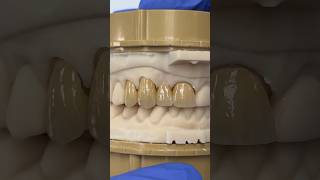 Splinted Zen Enamel and Monet Pure Zirconia EnvisiontecMain envisiontec lsk121shorts teeth [upl. by Toh]