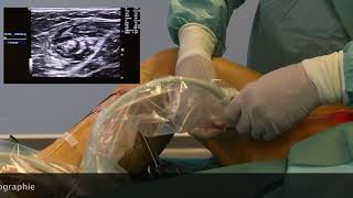 Traitement des varices par laser endoveineux [upl. by Oine]