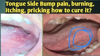 Tongue Side Bump painingHow to Cure Tongue papillae irritationTongue side bump is Itchy pricking [upl. by Siward]