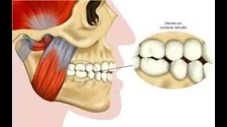 Rechinido dental [upl. by Sihtnyc]