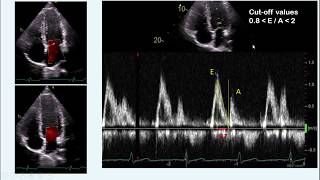 diastolic dysfunction part I  concept amp measurement [upl. by Enninaej]