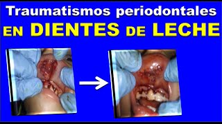 TRAUMATISMO DENTOALVEOLAR INFANTIL LUXACIÓN INTRUSIÓN 𝐘 EXTRUSIÓN [upl. by Ilatan]