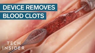 How This Device Safely Removes Blood Clots  Tech Insider [upl. by Odessa158]