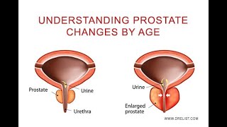 Age changes in the prostate Gland Normal Enlarged and benign prostatic hypertrophy [upl. by Hsara]