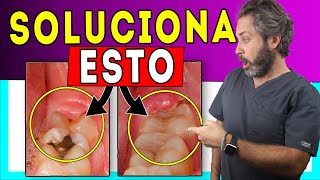 🚩Encía 𝐈𝐍𝐅𝐋𝐀𝐌𝐀𝐃𝐀 Muela del Juicio 💊Tratamiento de 𝙋𝙀𝙍𝙄𝘾𝙊𝙍𝙊𝙉𝘼𝙍𝙄𝙏𝙄𝙎 del tercer molar 𝗦𝗨𝗣𝗘𝗥𝗖𝗹𝗮𝗿𝗼 👌 [upl. by Enomas820]