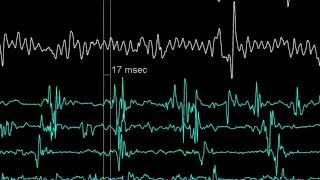 Reducing Noise Levels in Electrophysiology Medical Procedures [upl. by Aikkan702]