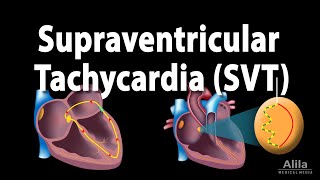 Supraventricular Tachycardia SVT PSVT Animation [upl. by Renfred]