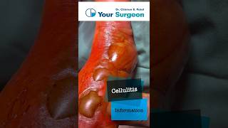 Cellulitis  Complete Information  What is Cellulitis  Treatment Options  Reasons  Debridement [upl. by Phares5]