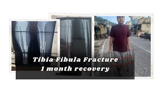 Recovery from Fracture in 30 Days  Tibia and fibula Middle Fracture  Leg Fracture Recovery [upl. by Cousins301]