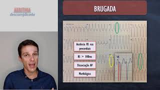 Critérios de Brugada para diagnóstico de taquicardia ventricular [upl. by Daberath]