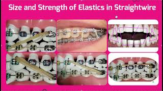 Size and Strength of Elastics for Straightwire Braces Triangle Box Class 2 Class 3 [upl. by Reamy]