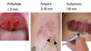 Bleeding diathesis Hemorrhagic Diathesis made simply [upl. by Aihsekan]