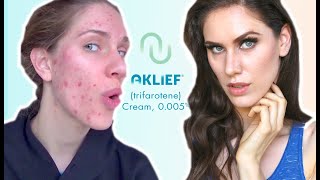 FIRST NEW ACNE MED IN 20 YEARS  AKLIEF  Trifarotene Cream 0005 Review amp Impressions [upl. by Rodnas770]