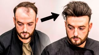 Mens Hair Loss Treatment  Hairstyle Transformation  Does it Work [upl. by Lemrahs809]