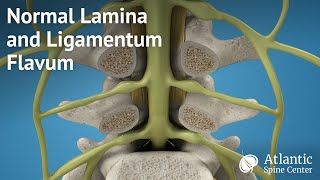 Normal Lamina and Ligamentum Flavum [upl. by Noiram]