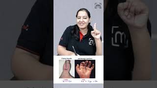 1 minute learning Osler Node and Janeway Lesion  MedLive  Dr Priyanka Sachdev [upl. by Ettenna]