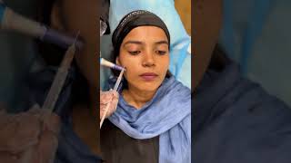 Microneedling treatment for scars skincare microneedling acne scars trendingshorts viralvideo [upl. by Yereffej]