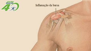 BURSITE NO OMBRO  CAUSAS SINTOMAS E TRATAMENTO [upl. by Cung]