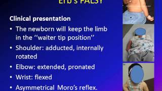 Obstetric Brachial Plexus Palsy OBPP Erbs Palsy [upl. by Summons]