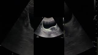 Right ovarian dermoid cyst ultrasound doctor [upl. by Luwana823]