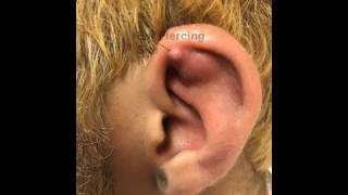 Left Ear Helix Abscess Chondritis or Not [upl. by Linetta]