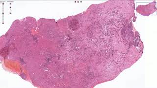 Metastasis of Pancreatic Adenocarcinoma to the Liver  Histopathology [upl. by Kciredes532]