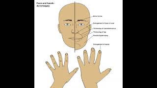 Acromegaly definition amp Meaning Health Healthcare Healthtips [upl. by Atsirt]