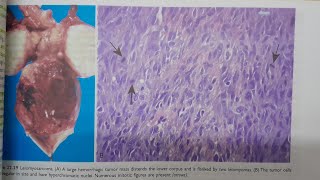 Leiomyosarcoma  SPECIAL PATHOLOGY [upl. by Neelyk368]