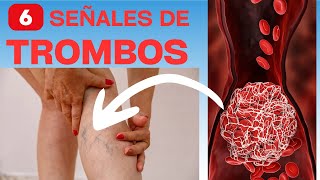 6 señales de que tendrás trombosis o coágulos [upl. by Adiraf]