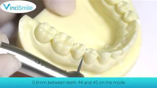 Work Tips Interproximal Enamel Stripping IPR） [upl. by Obelia211]