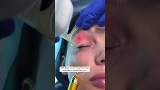 Co2 Laser Skin Resurfacing for Eyelids  Skin Tightening [upl. by Arah839]