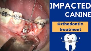 IMPACTED CANINE exposure treatment with ORTHODONTICS and braces  Step by step [upl. by Esirahc]