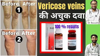 Homeopathic medicine for Varicose veins पैरों में उभरी हुई नीली नसें  Varicose veins treatment [upl. by Stephannie]