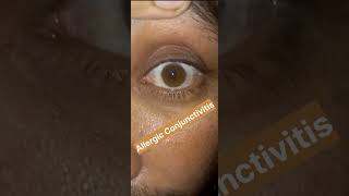 Allergic Conjunctivitis Shorts AllergicConjunctivitis [upl. by Mill]